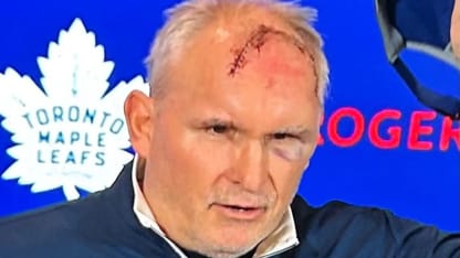 Maple Leafs Craig Berube shows off forehead stitches