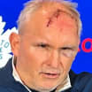 Maple Leafs Craig Berube shows off forehead stitches