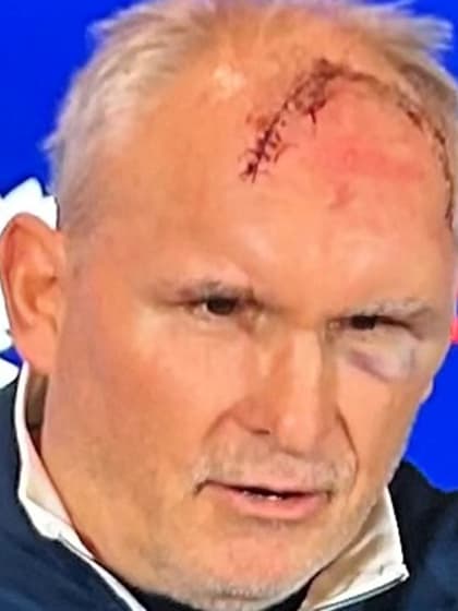 Maple Leafs Craig Berube shows off forehead stitches